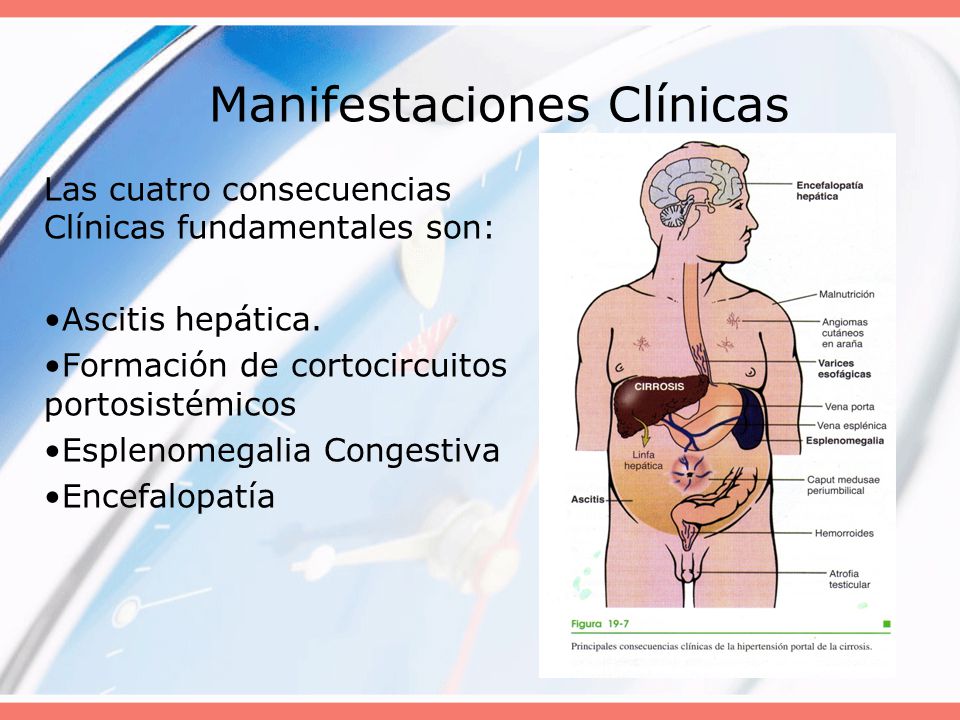 Sindrome de hipertension portal causas de presion